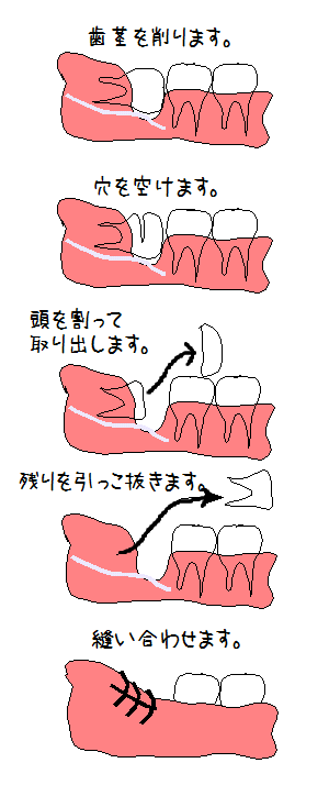 抜き方